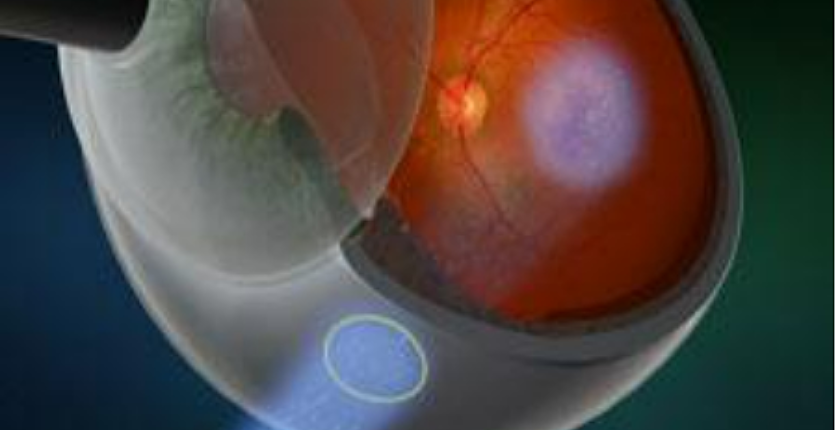 PRL1 Retina